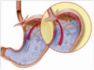Τι είναι και πως αντιμετωπίζεται διατροφικά η γαστροοισοφαγική παλινδρόμηση