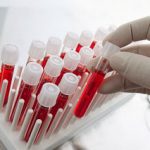 Τι δεν πρέπει να τρώτε αν έχετε υψηλό ουρικό οξύ
