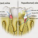 Νέα μέθοδος διάγνωσης περιοδοντίτιδας με ελληνική σφραγίδα