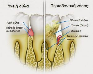 Νέα μέθοδος διάγνωσης περιοδοντίτιδας με ελληνική σφραγίδα