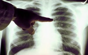 Νέα, ελπιδοφόρα θεραπεία για τον καρκίνο του πνεύμονα