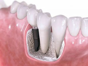 Προσοχή στα οδοντικά εμφυτεύματα αμφιβόλου προελεύσεως