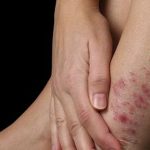 H μεσογειακή διατροφή μπορεί να επιβραδύνει την εξέλιξη της ψωρίασης