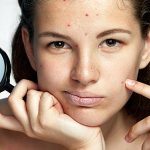 Διατροφικές οδηγίες για την αντιμετώπιση της ακμής